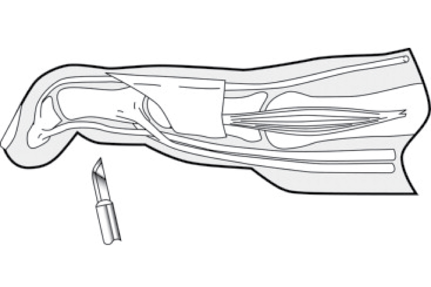 Flexor Tenotomy 