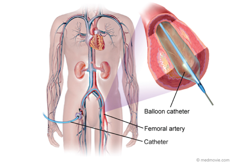 Peripheral Angioplasty