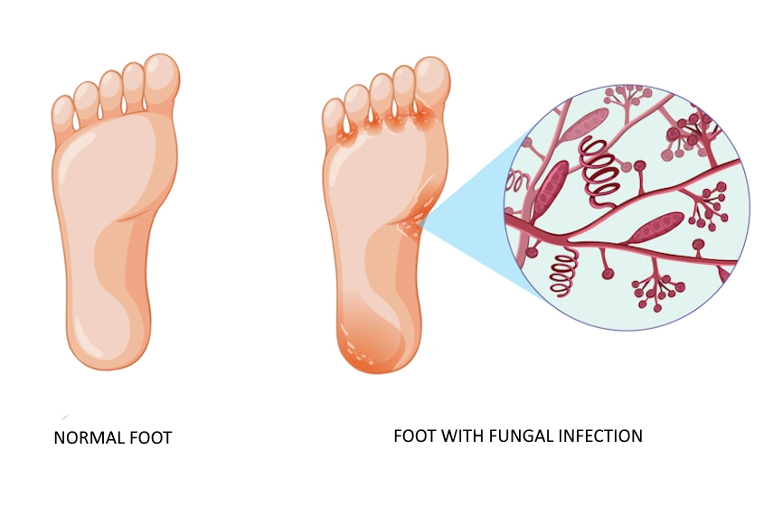 Fungal Infection Treatment for Diabetic Feet