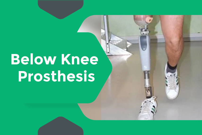 Below Knee Prosthesis - Below Knee Amputation - Amputees - What We