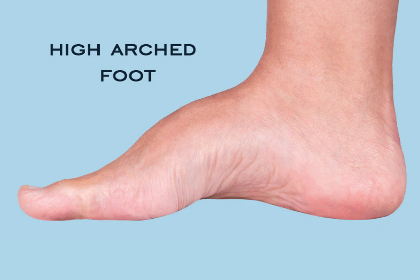 High Arch Foot