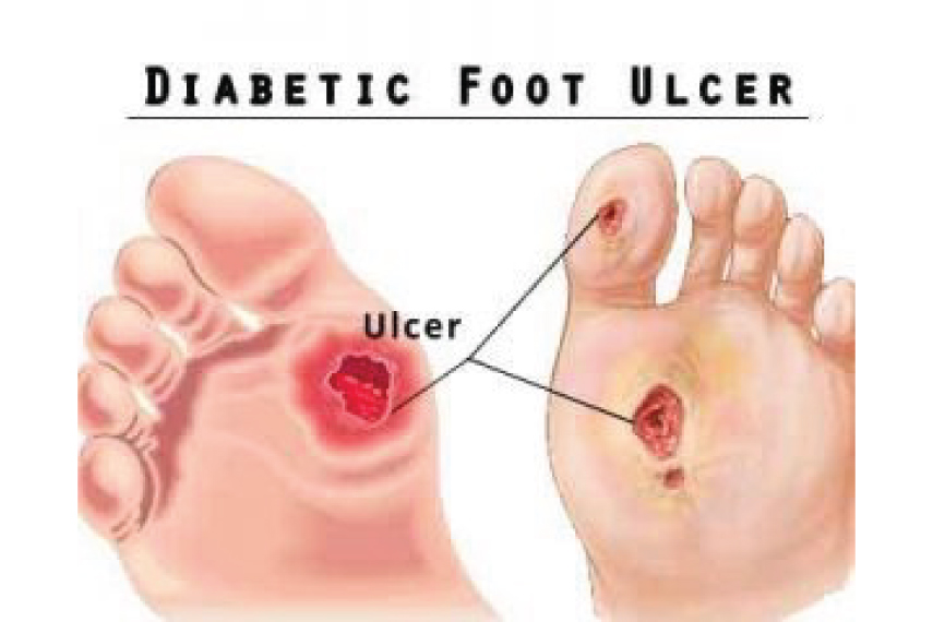 Nonhealing Ulcer